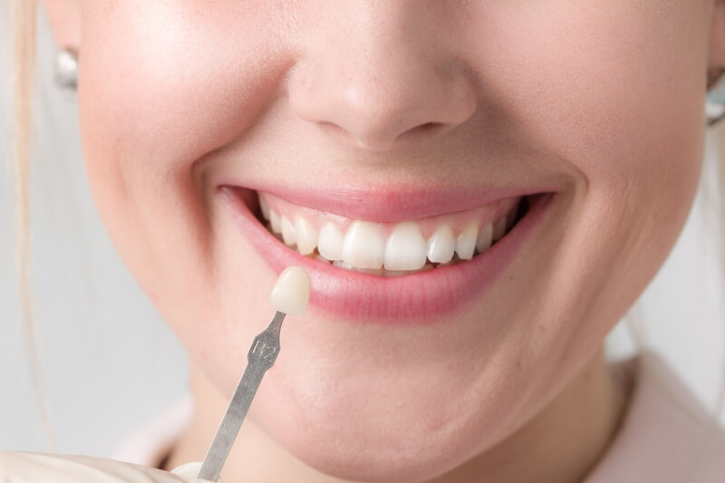 Veneers Tunbridge Wells – What Are Their Benefits?